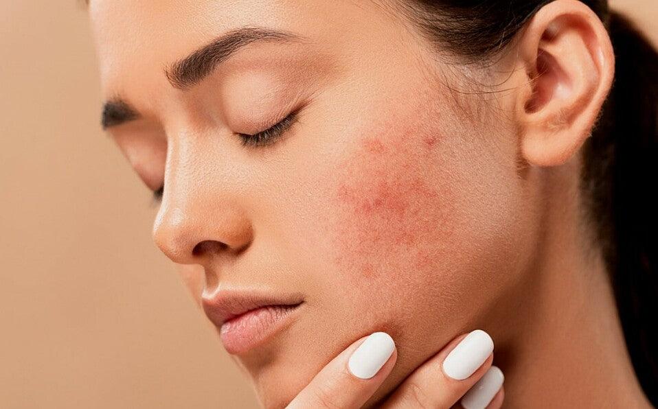 como tratar la piel sensible e irritable chok chok beauty 283f9f25 7a1c 4feb a13d 27380a68d8de